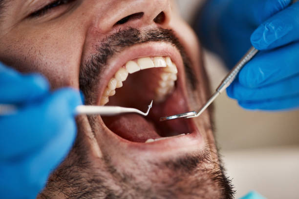 Best Emergency Tooth Extraction in Eldorado, TX